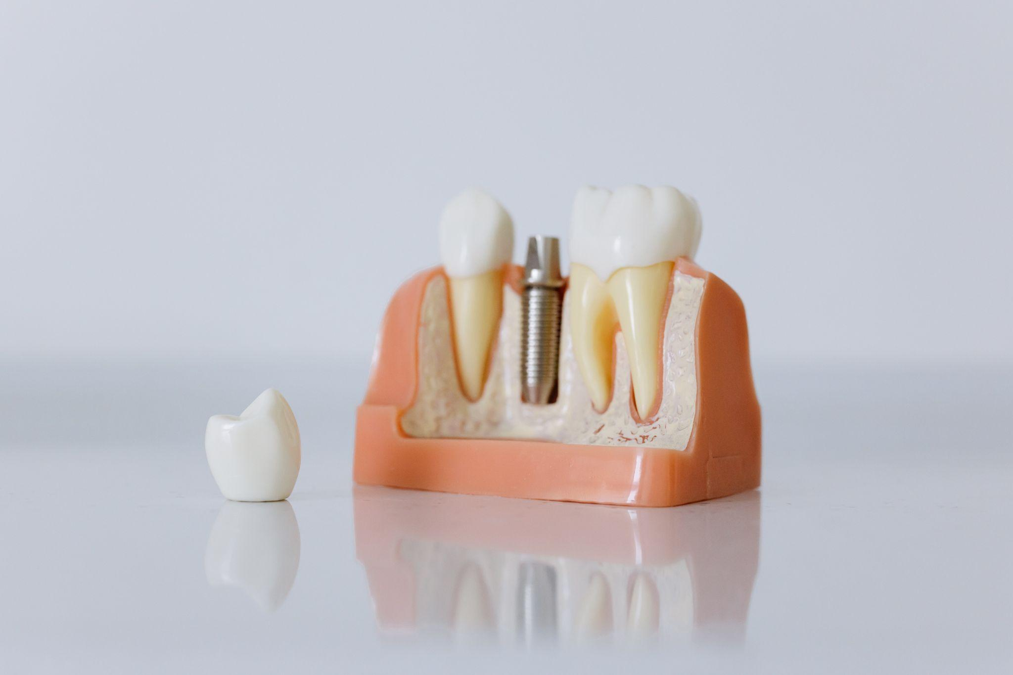 Picture of dental implants