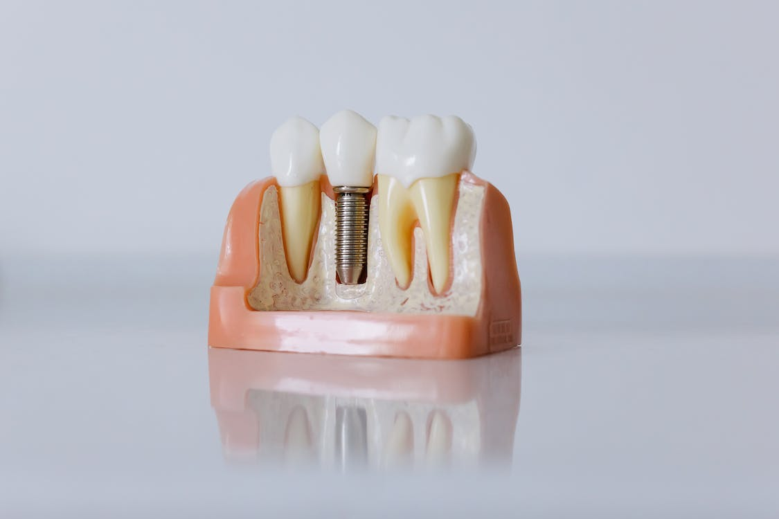 Picture of dental implants